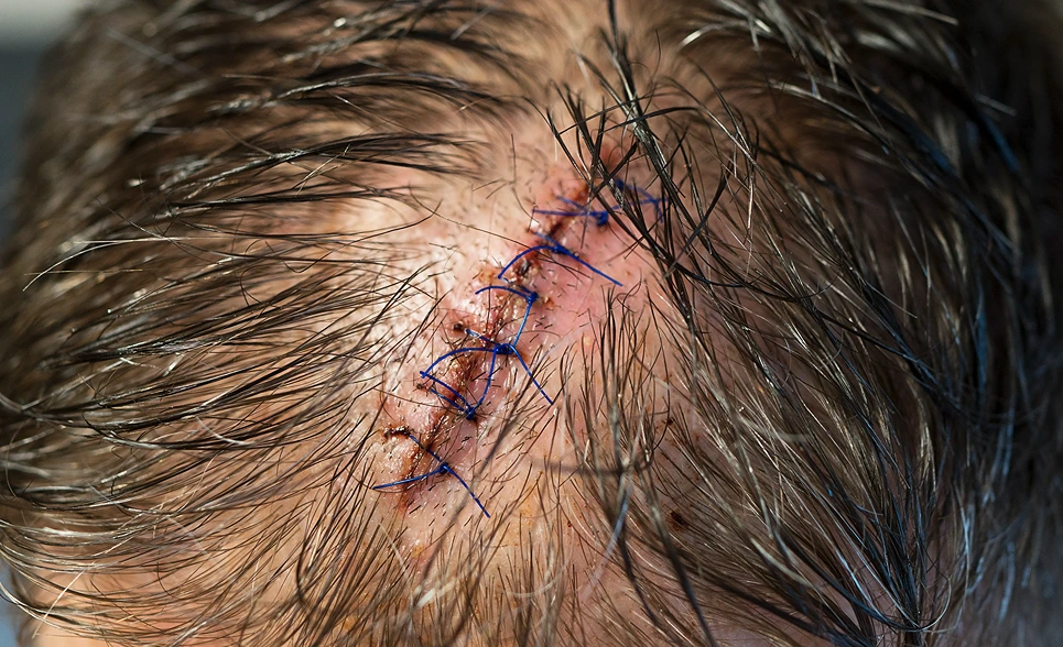 Close-up of a stitched surgical incision on a person's scalp with wet hair strands.