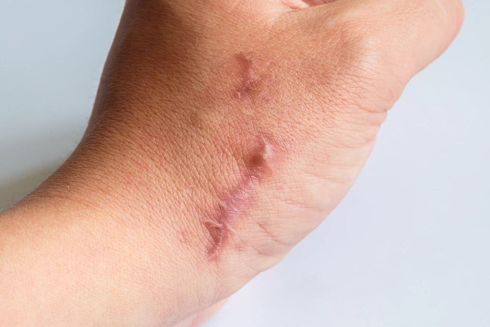 Close-up of a healed scar on a person's wrist, showing pink, slightly raised tissue on light skin.
