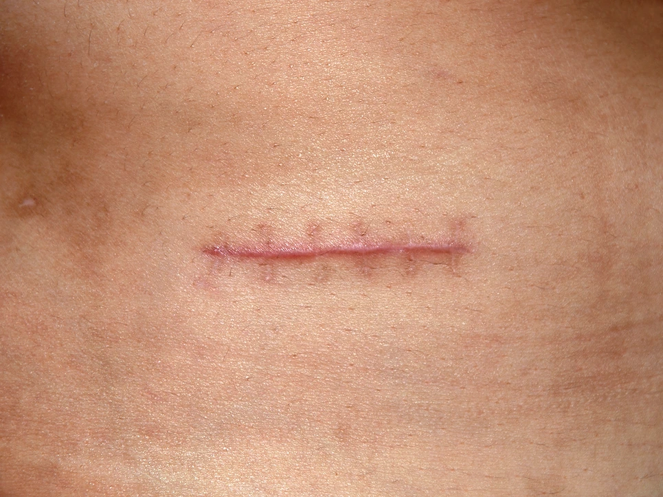 Close-up view of a healed scar on human skin.