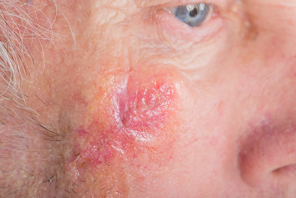 Close-up of a red, inflamed skin rash on an elderly person's face near the eye.