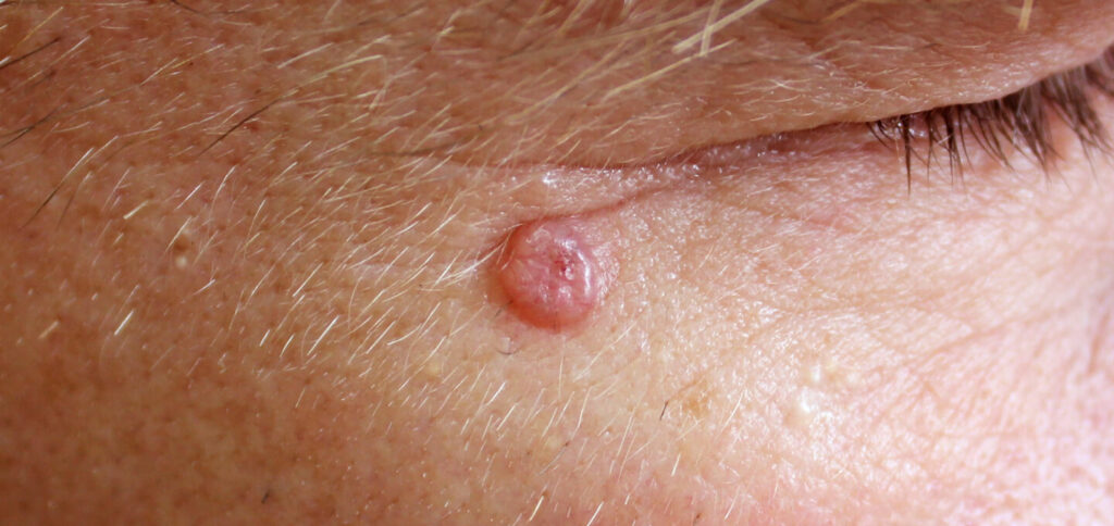 Basal Cell Carcinoma Dermatology And Skin Health Dr Mendese 