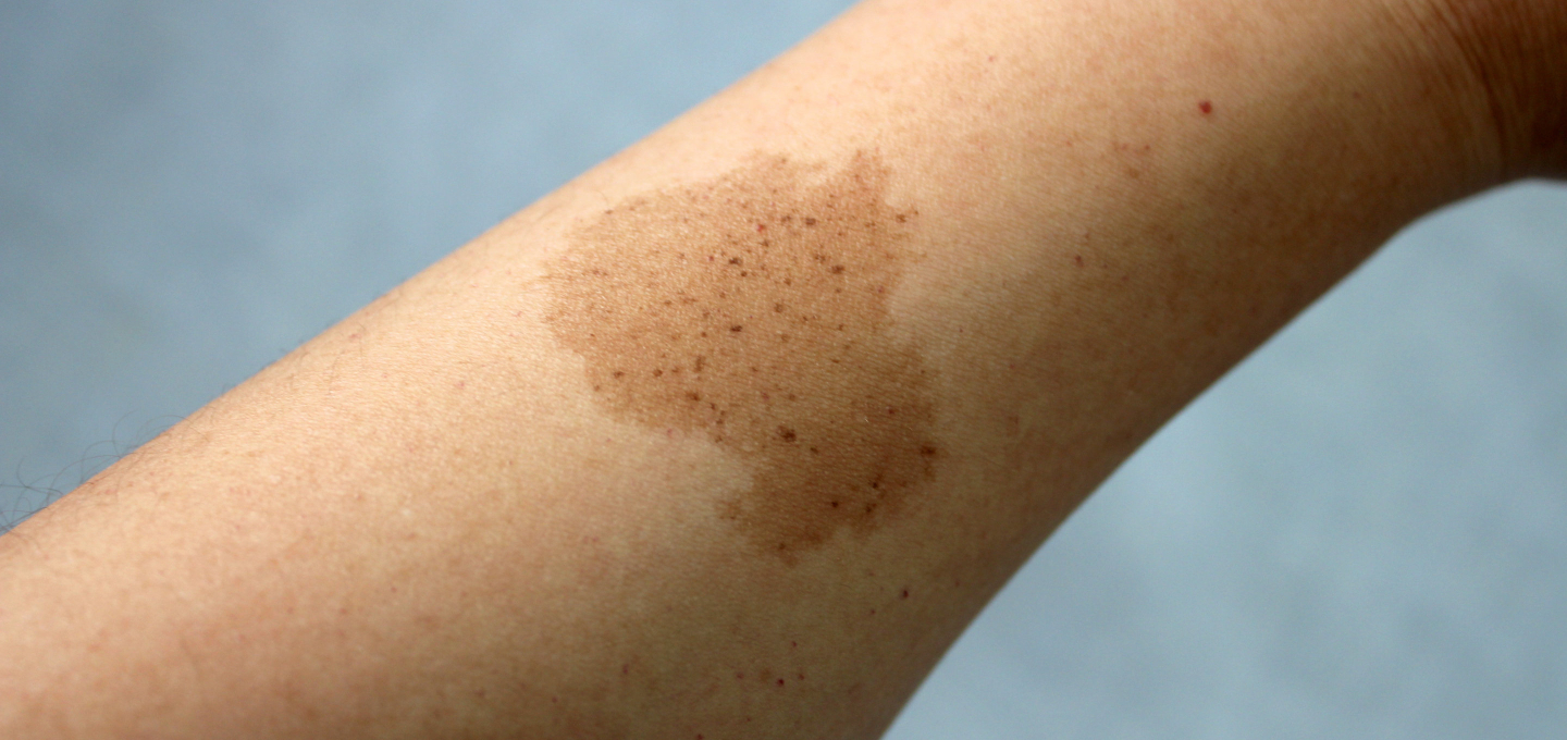 A person's arm with a brown splotch on it.