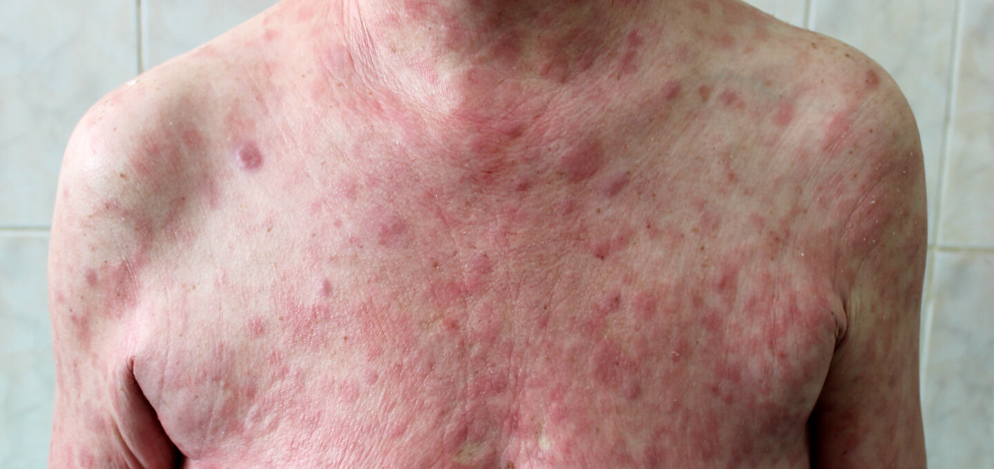 A man with a rash on his chest.
