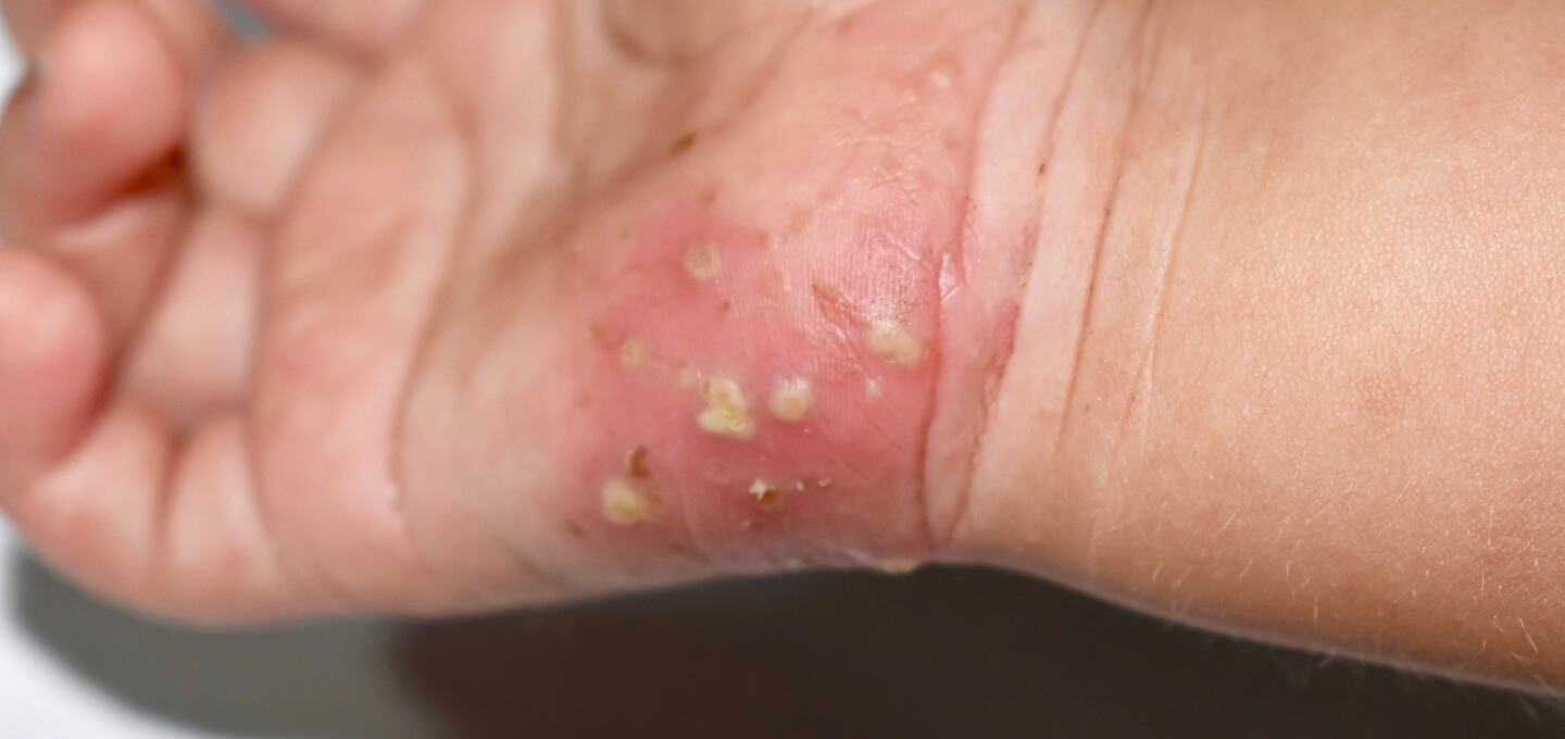 scabies burrows