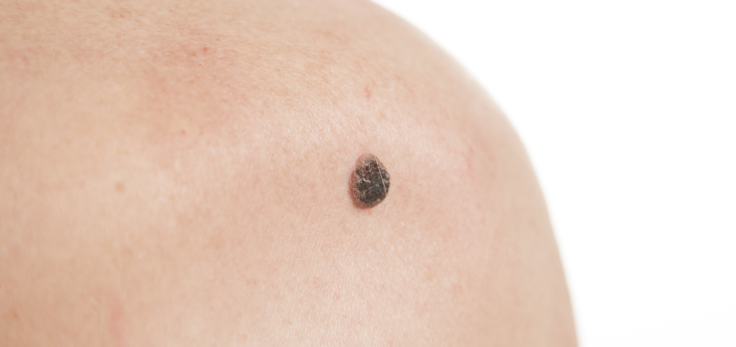 A woman with a mole on her back.