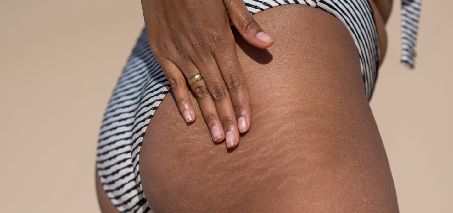 How to Deal with Stretch Marks