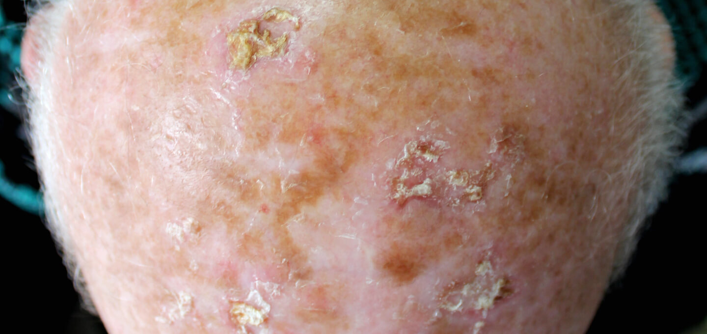 A close up of a man's skin with psoriasis.