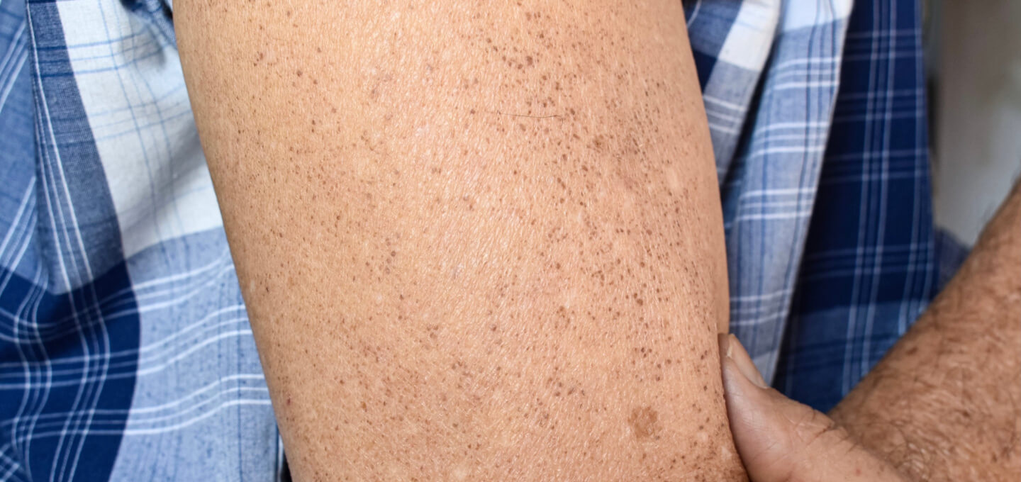 Brown Spots  Dermatology and Skin Health - Dr. Mendese