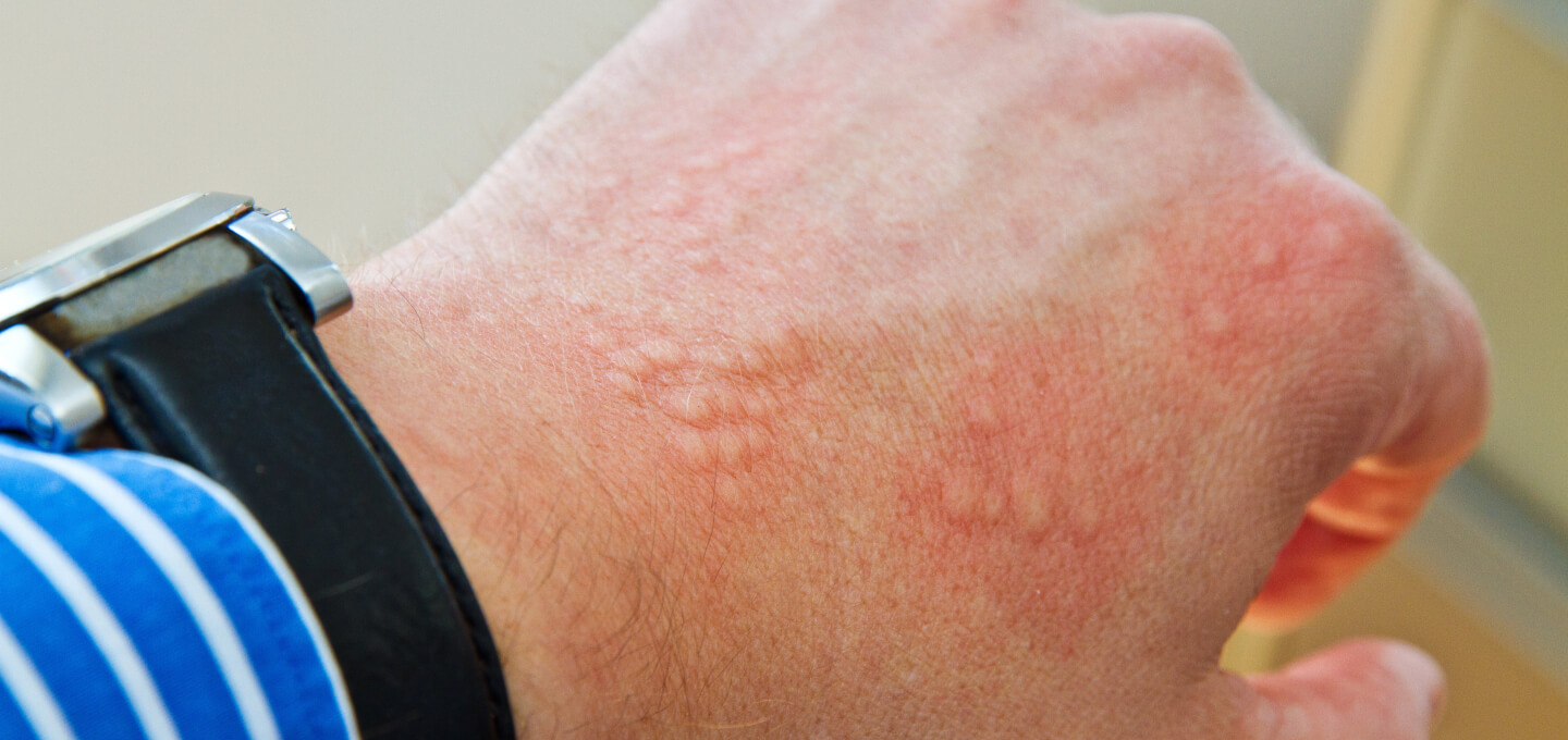 A person's wrist with a red mark on it.