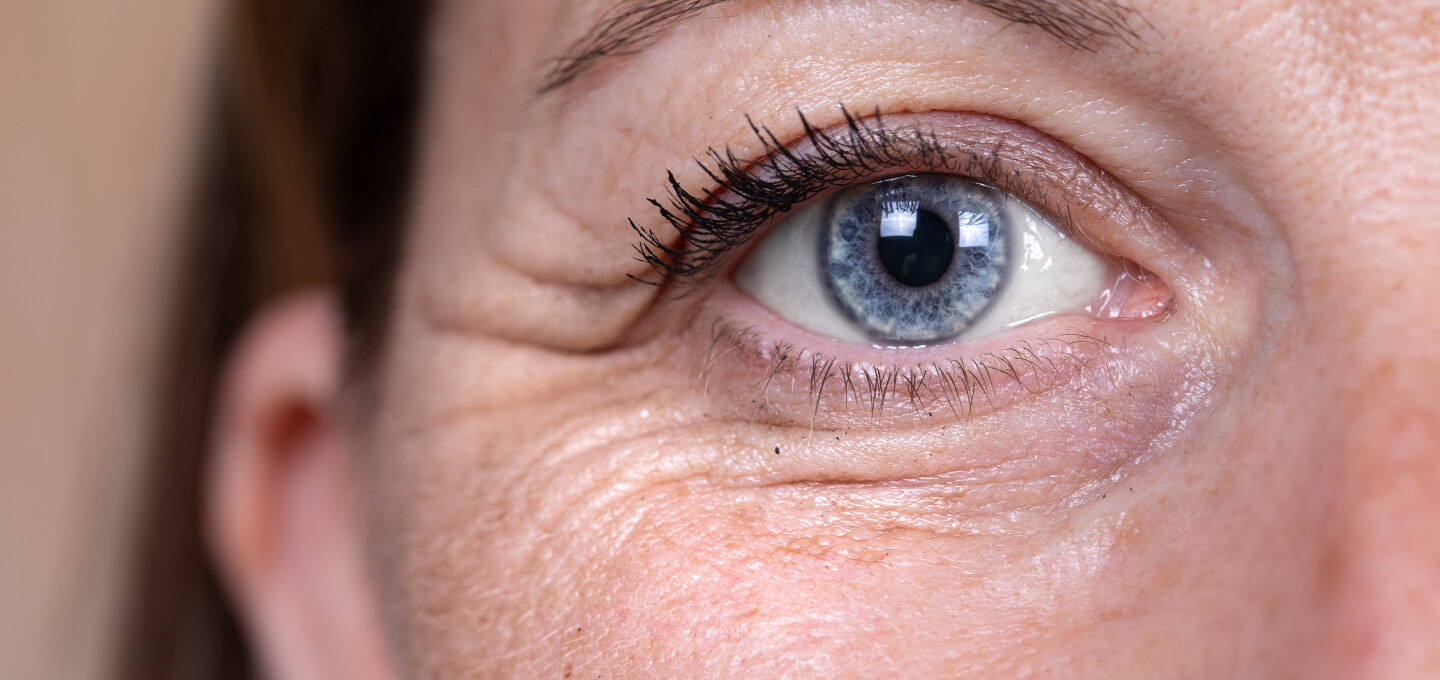 A close up of a woman's eye with wrinkles.
