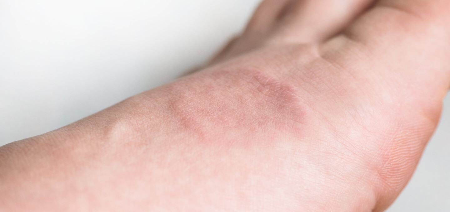 Common skin rashes and what to do about them