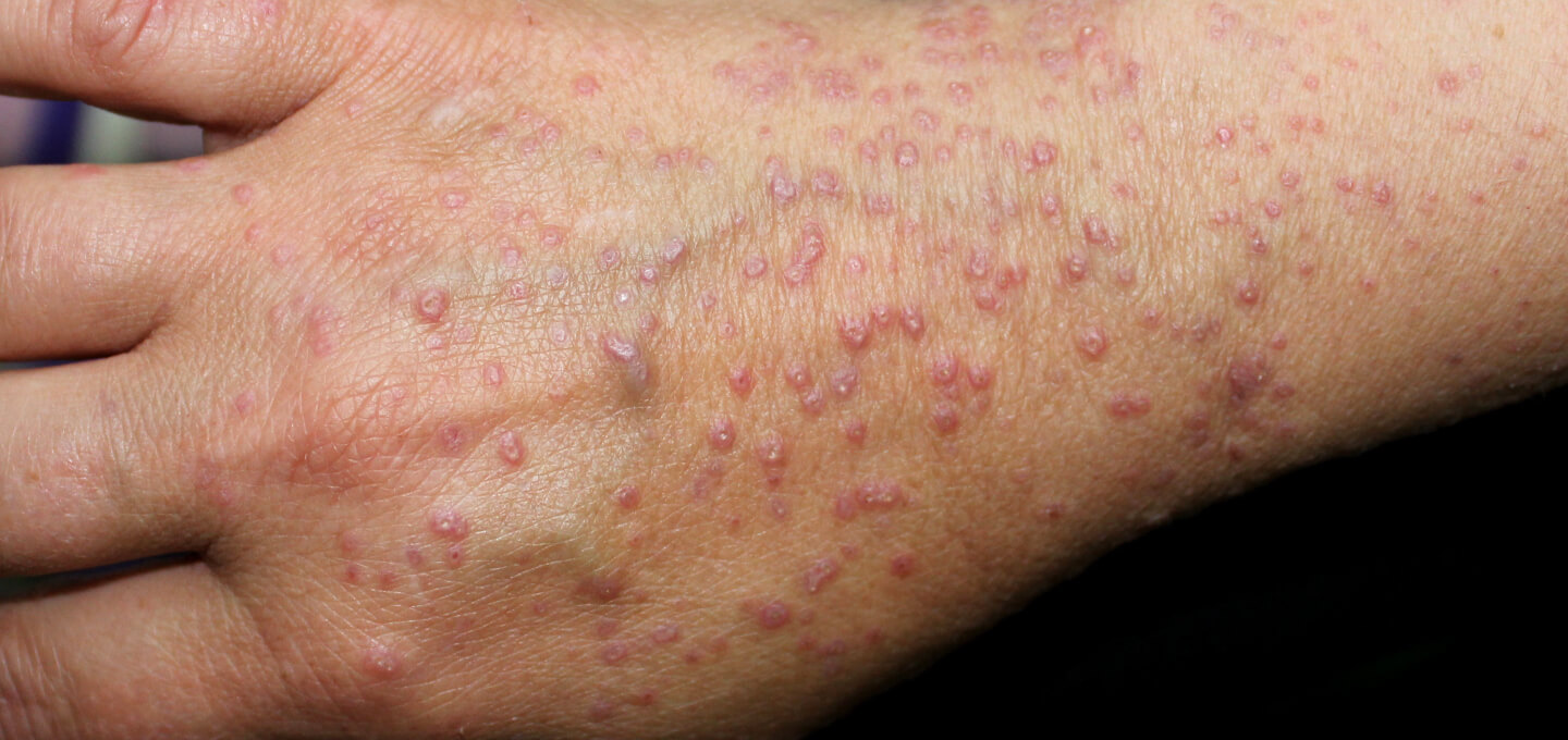 A person's hand with a lot of spots on it.