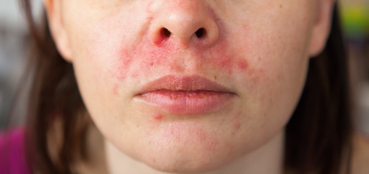 A close up of a woman with a red rash on her face.
