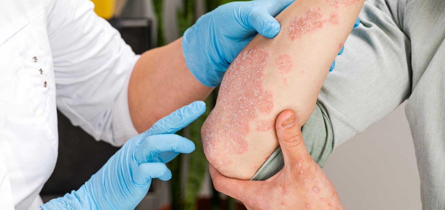 A doctor is examining a patient's arm with psoriasis.