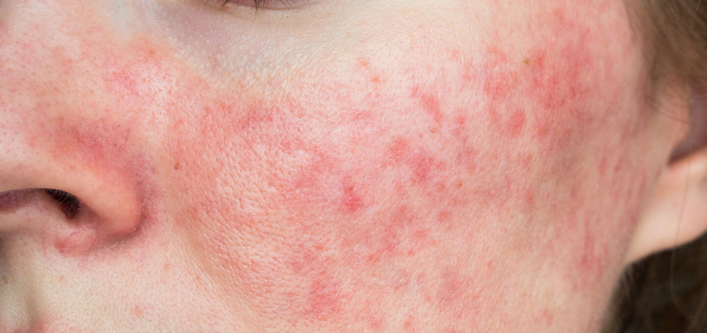 A close up of a woman's face with a red rash.