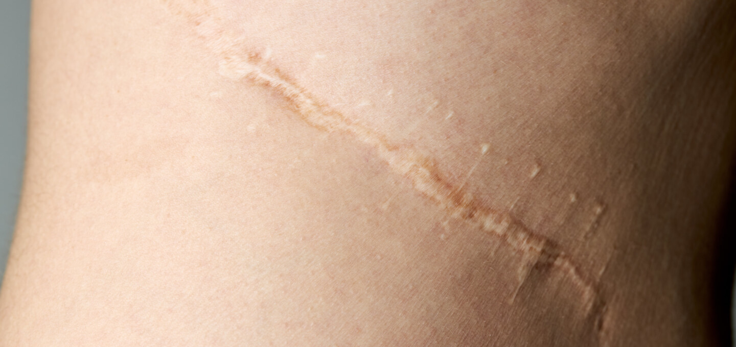 A person's leg with a scar on it.
