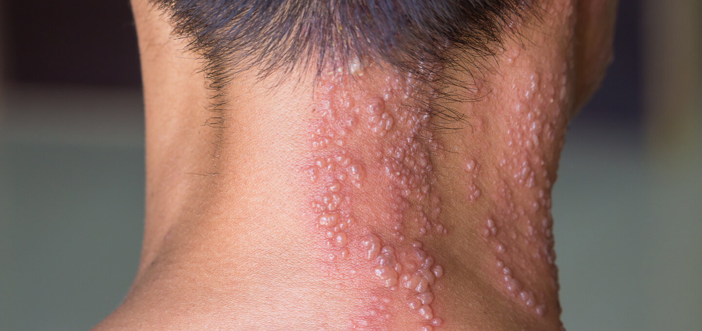 Beginning Stages Of Shingles On Neck