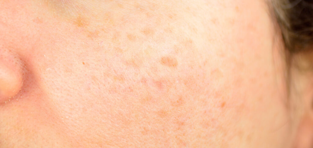 Sun Damaged Skin | Dermatology and Skin Health - Dr. Mendese