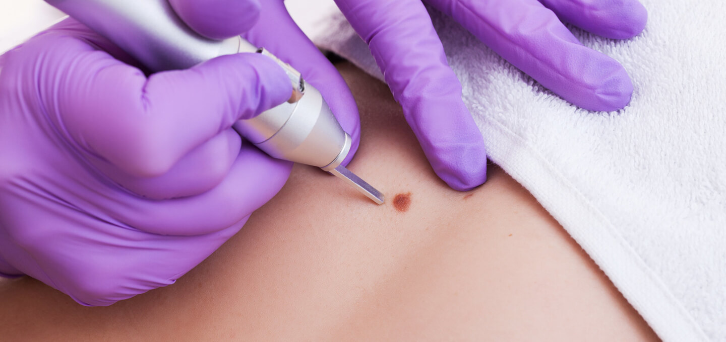 A woman using a needle to remove a mole on her stomach.