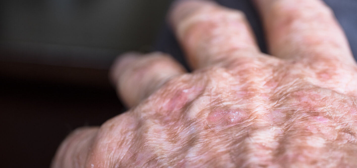 A close up of a person's hand with a rash.