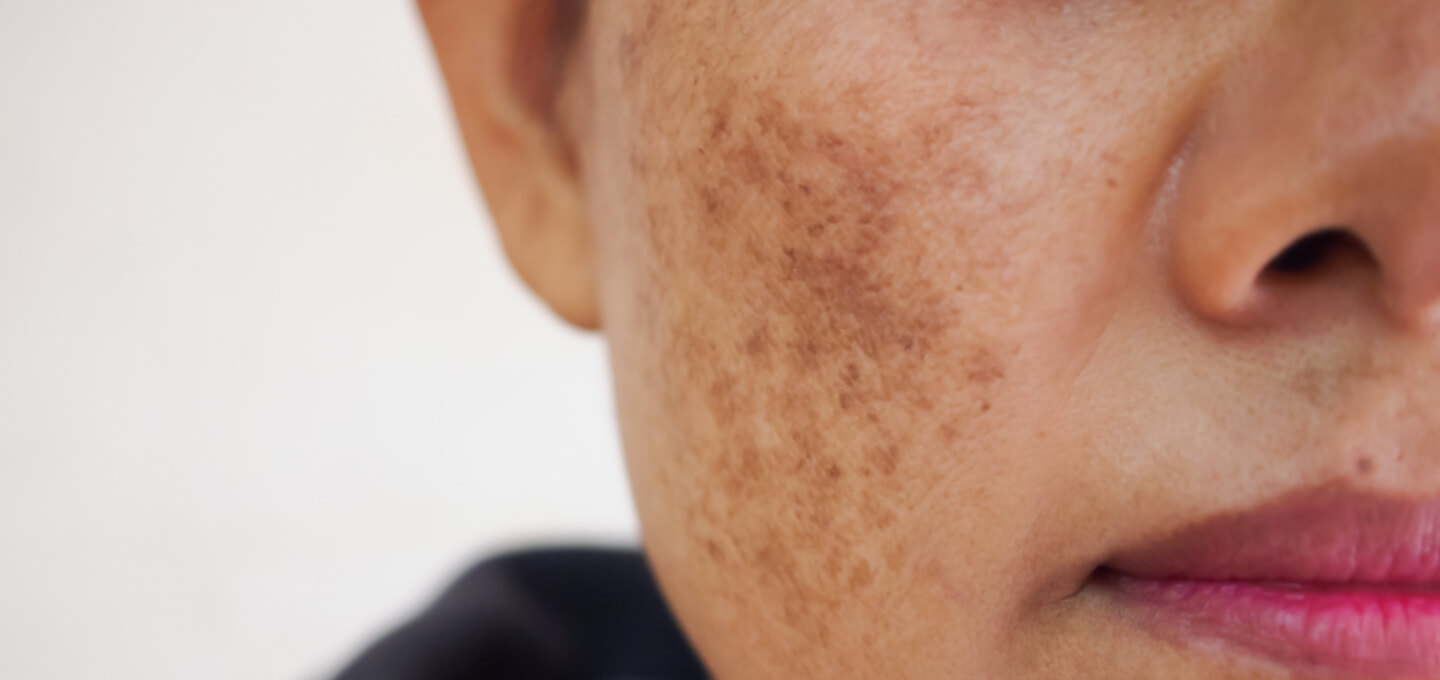 Brown Spots  Dermatology and Skin Health - Dr. Mendese