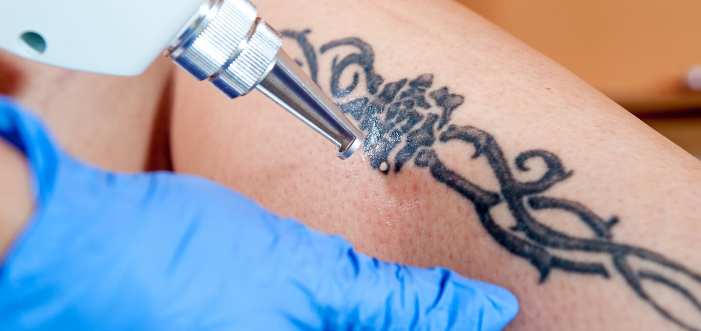 Tattoo removal dover