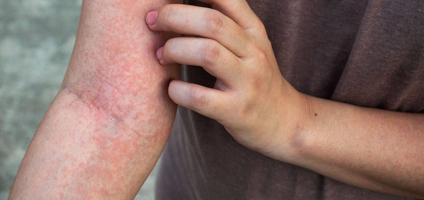 A person is holding a person's arm with a rash on it.