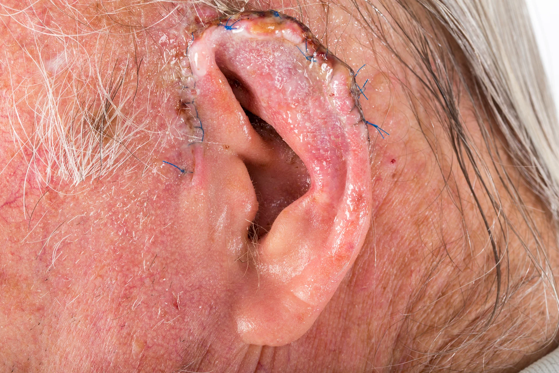 a patient underwent Mohs surgery on the ear