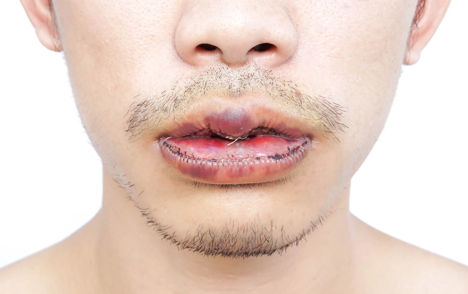 mohs surgery on the lips