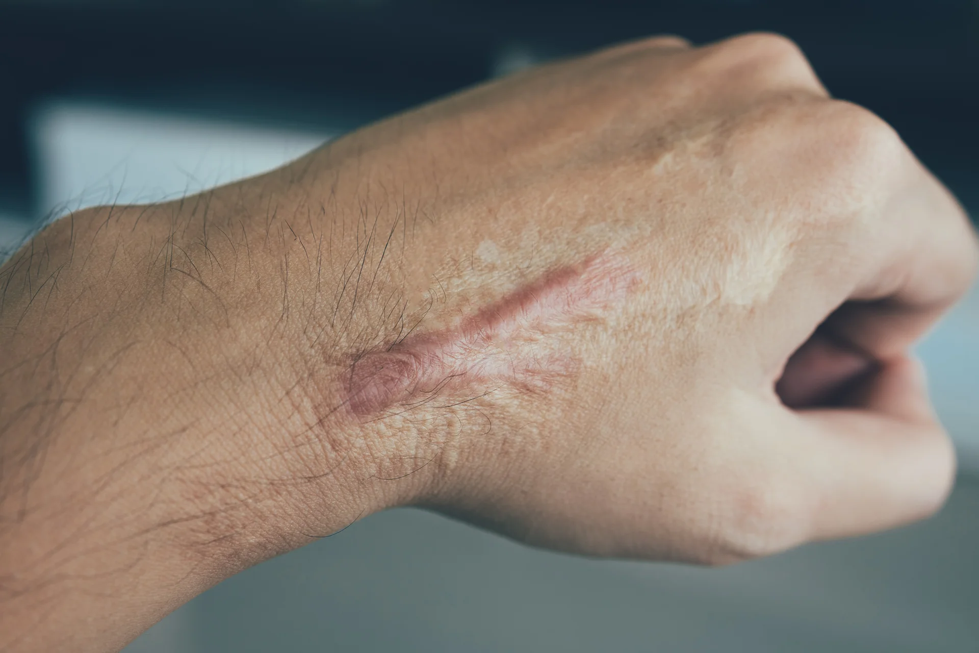 keloid scar in the hand