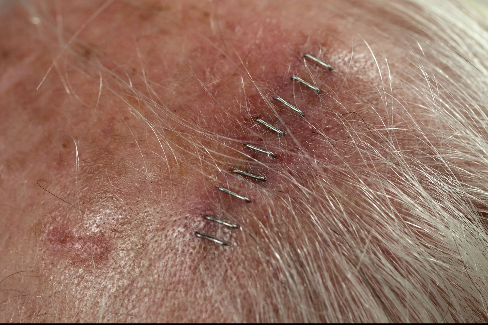 post-surgery of Mohs procedure on the scalp