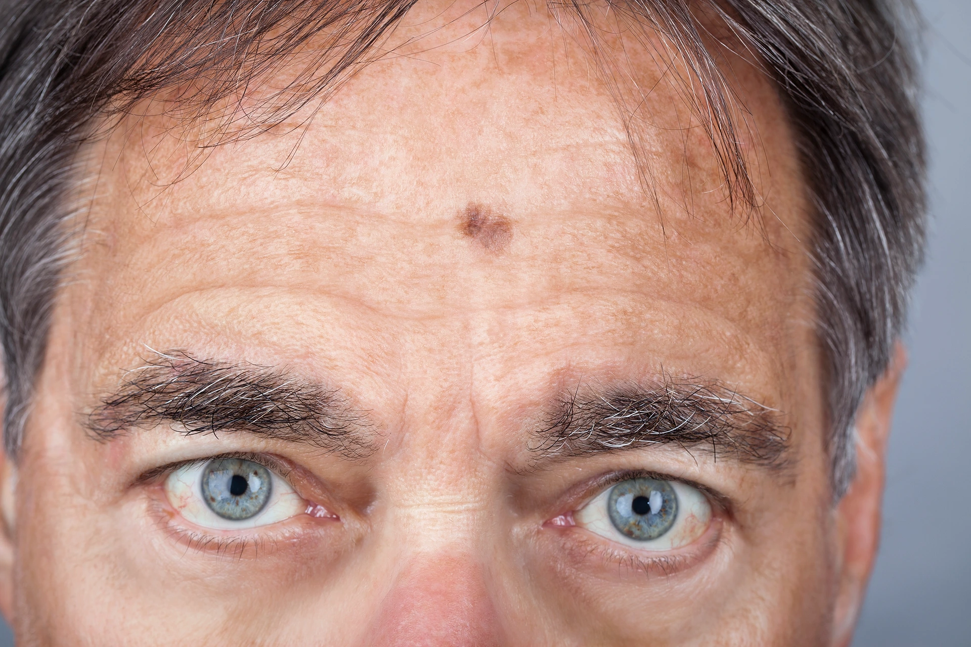 basal cell mohs surgery forehead