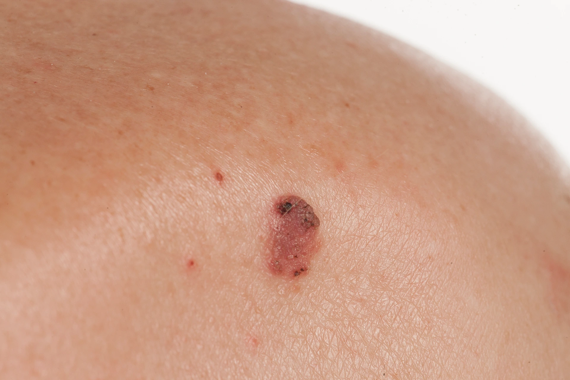 how soon should mohs surgery be done after basal cell carcinoma diagnosis