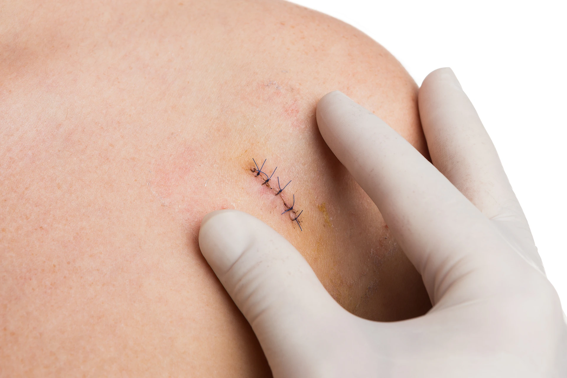 skin graft care after mohs surgery
