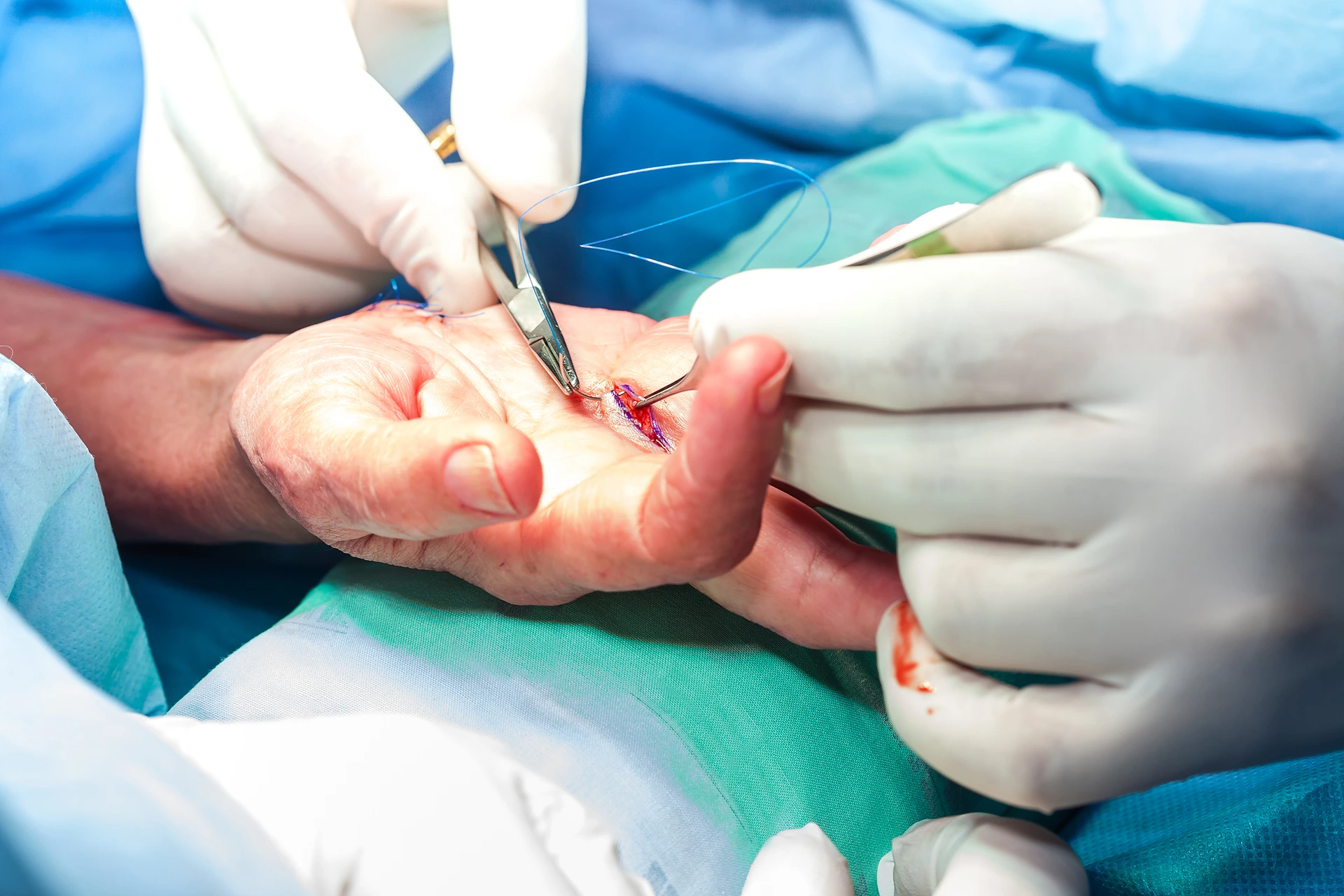 A hand is being operated on by a surgeon.