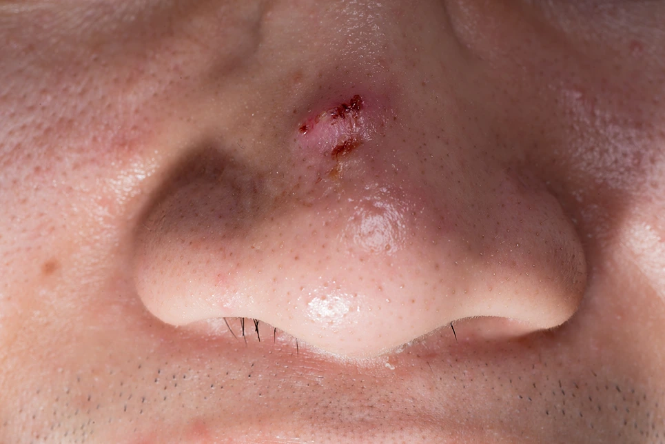 A close up of a man with a scar on his nose.