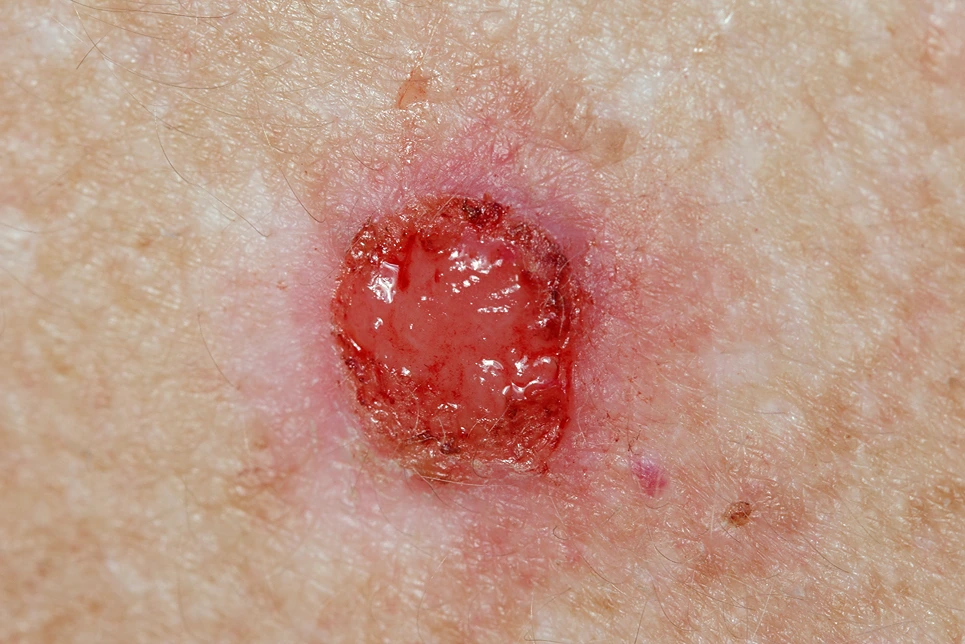 Close-up of a small, open wound on skin.