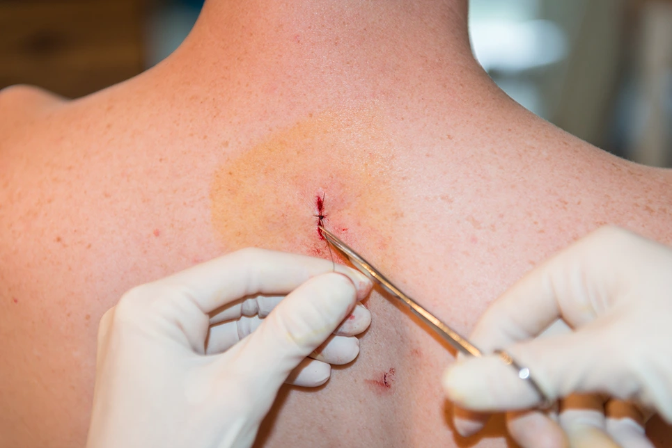A medical professional stitches a wound on a patient's neck.