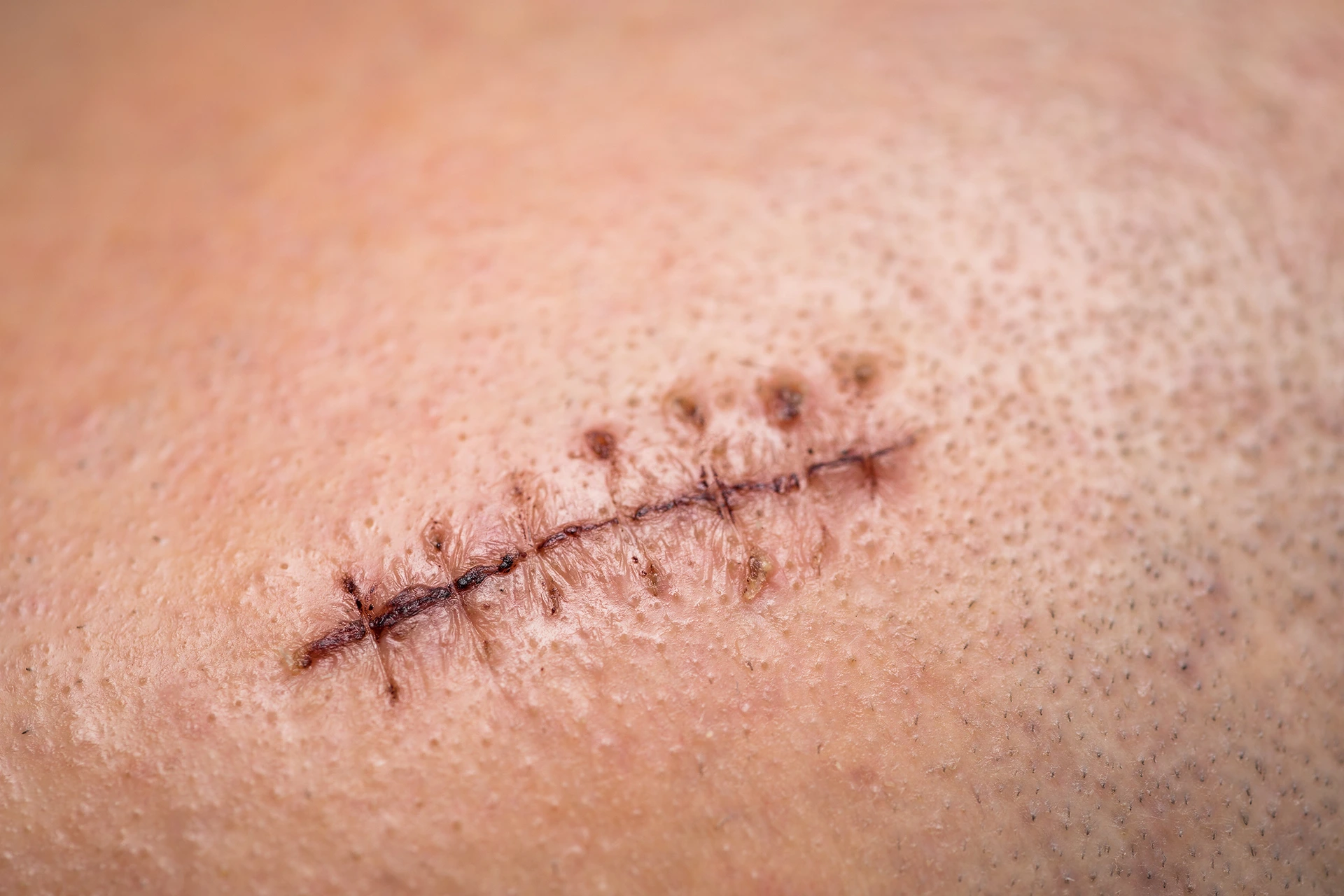 Close-up of skin showing a stitched surgical wound with slight bruising around the stitches.