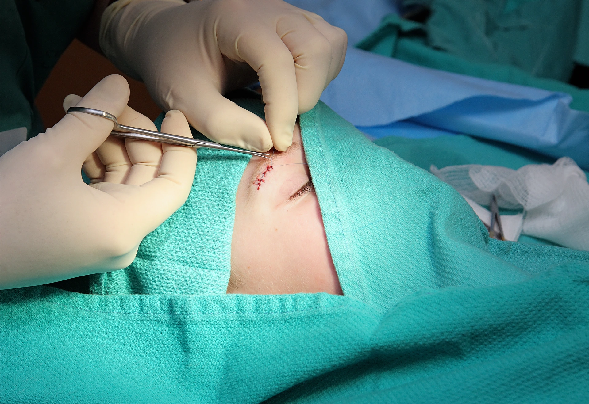 Two surgeons with gloved hands perform stitches on a person's eyebrow with surgical tools, surrounded by blue surgical drapes.