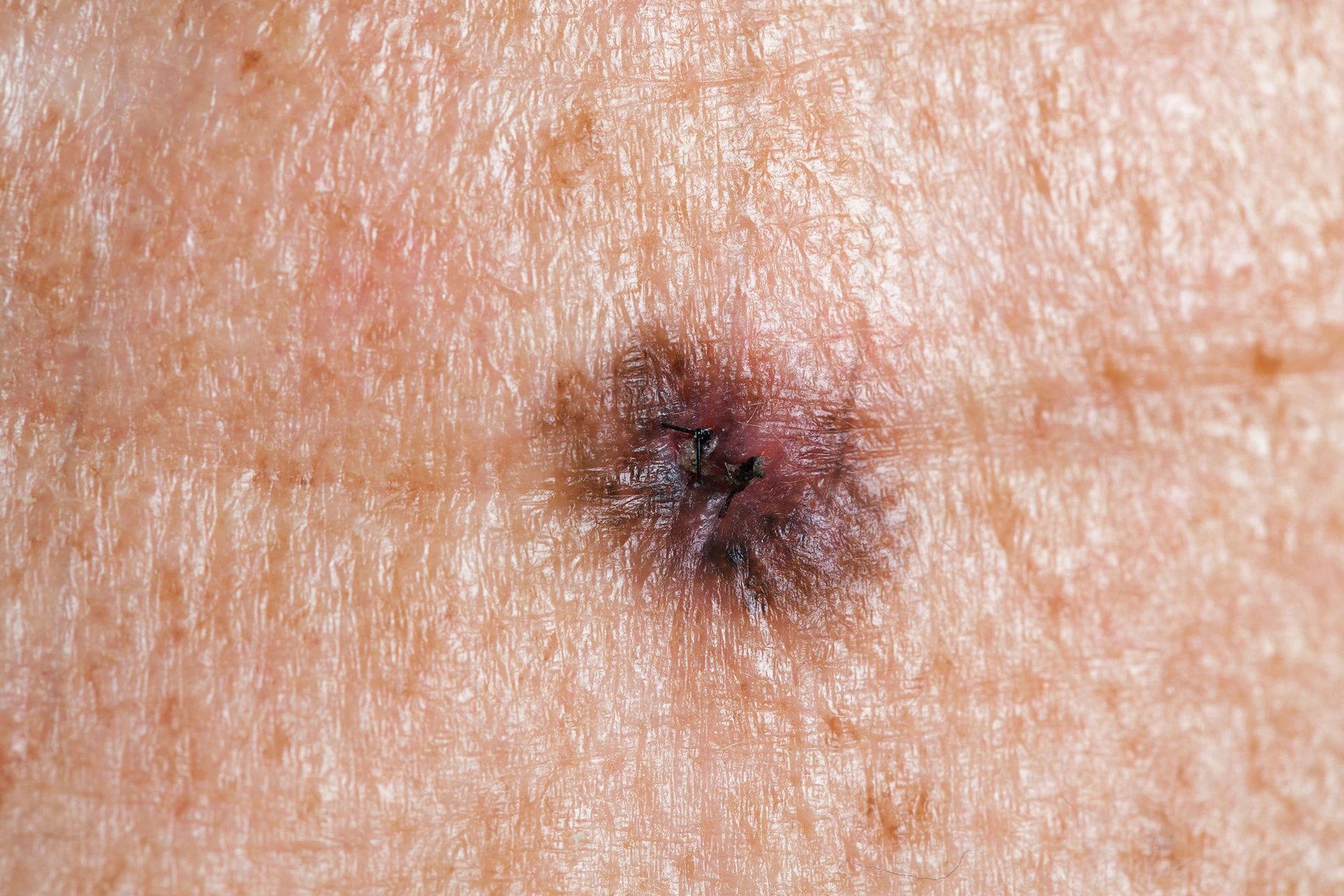 Close-up image of a small, irregularly shaped, dark lesion on skin with a slightly raised, crusty texture.