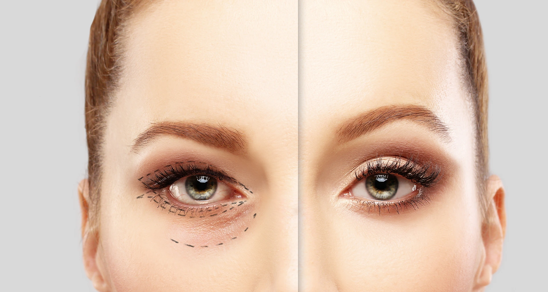 Close-up split view of a woman's face before and after cosmetic surgery, showing marked under-eye area on the left and smooth, contoured skin on the right.