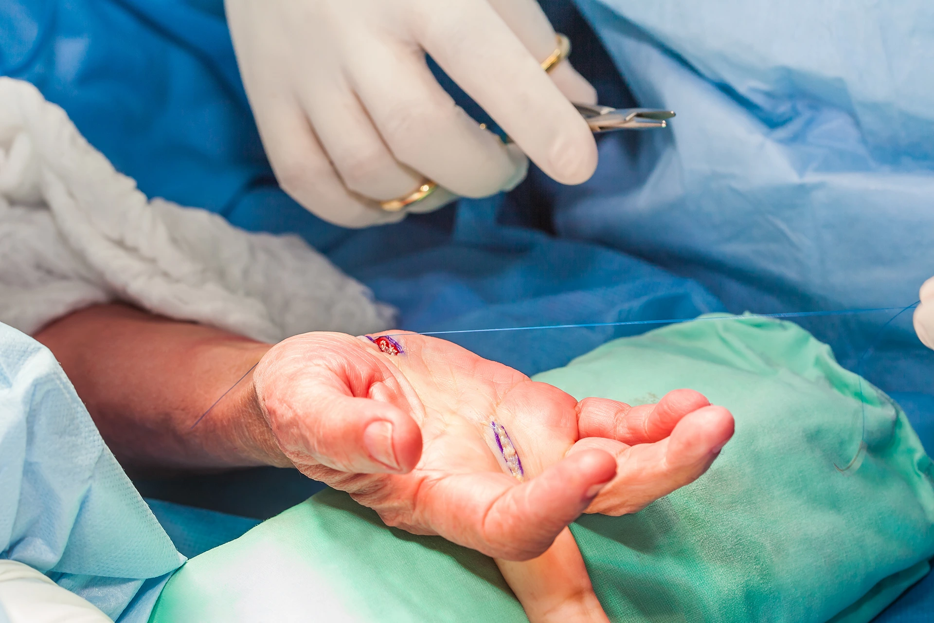 A surgeon's gloved hands suture a wound on a patient's hand during surgery. The patient’s hand is positioned on a surgical drape.