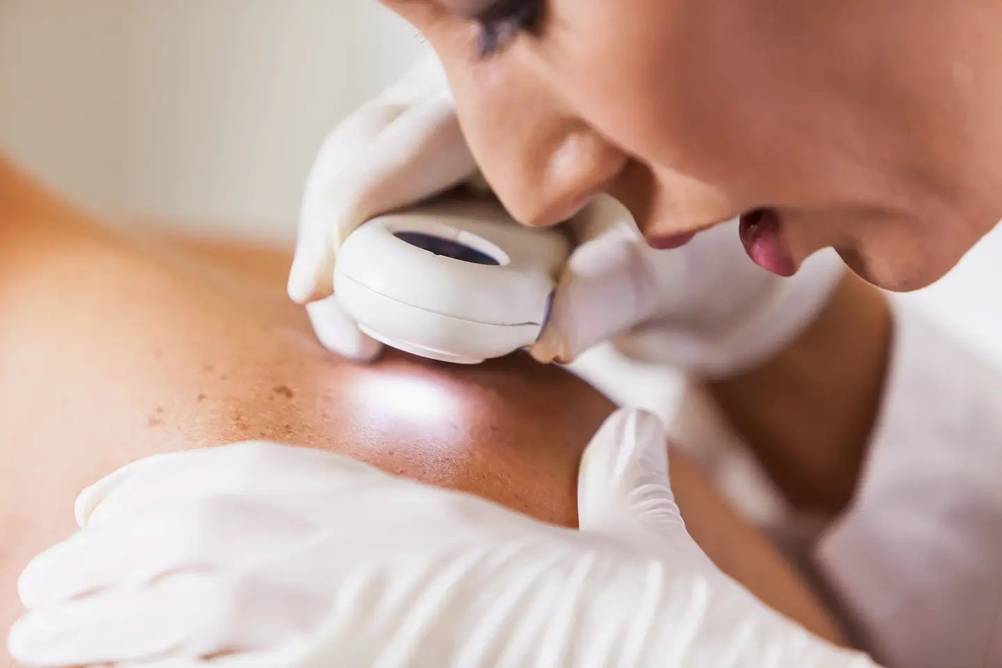 A person examines a mole on someone's skin using a dermatoscope while wearing gloves.