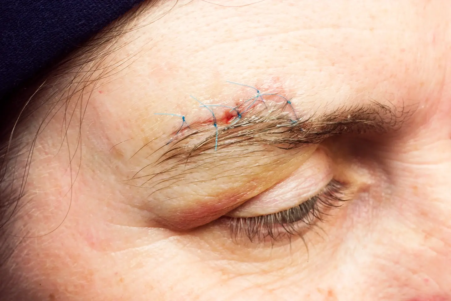 Close-up of a closed eye with stitches on the eyebrow, highlighting redness and slight swelling around the area.