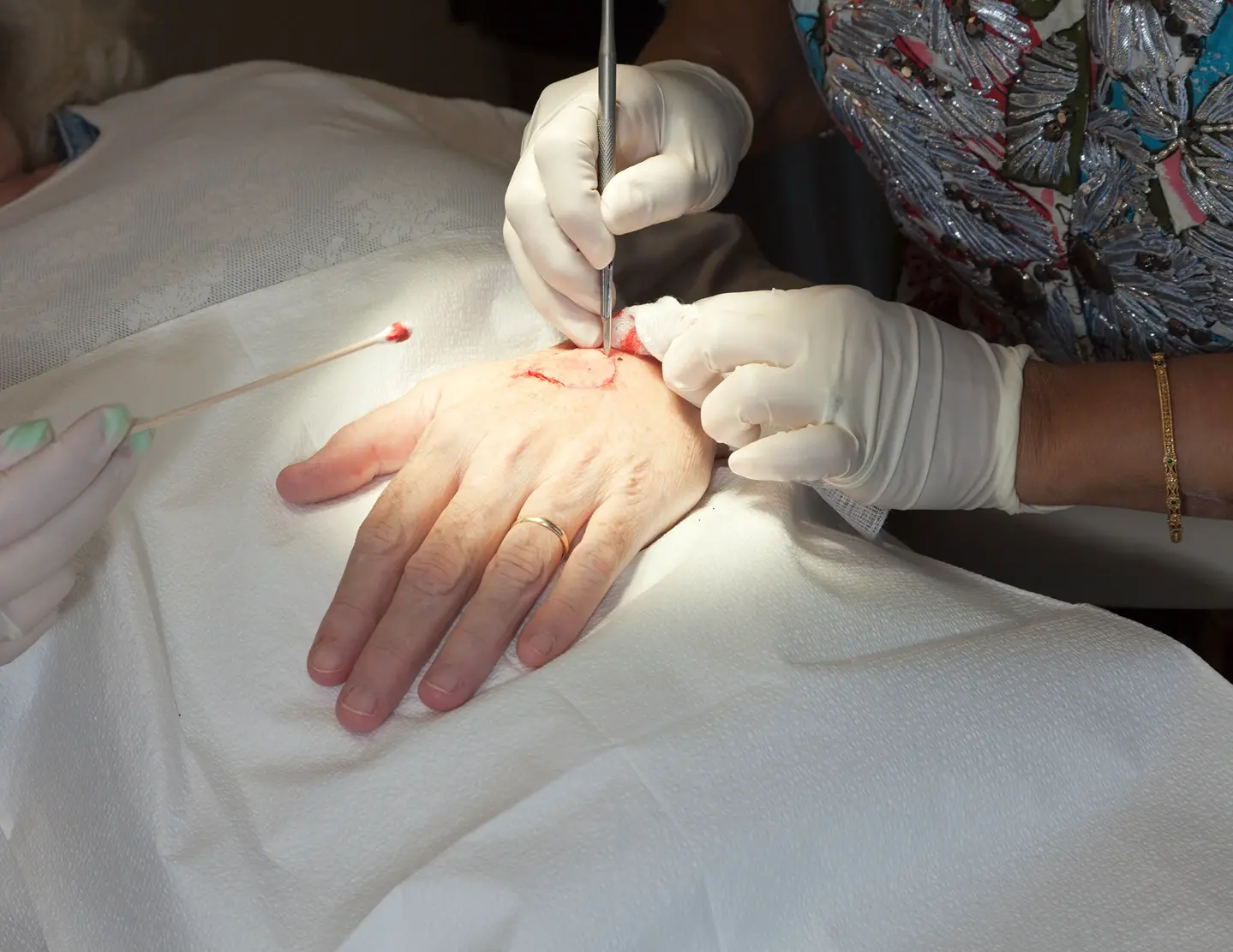 A medical professional in gloves is performing a procedure on a person's hand using surgical tools.