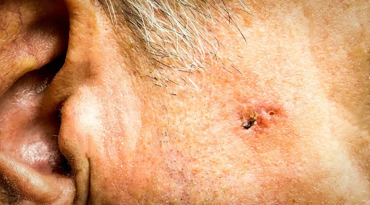 Close-up of a person's skin with a visible blemish or lesion near the ear and short gray hair.