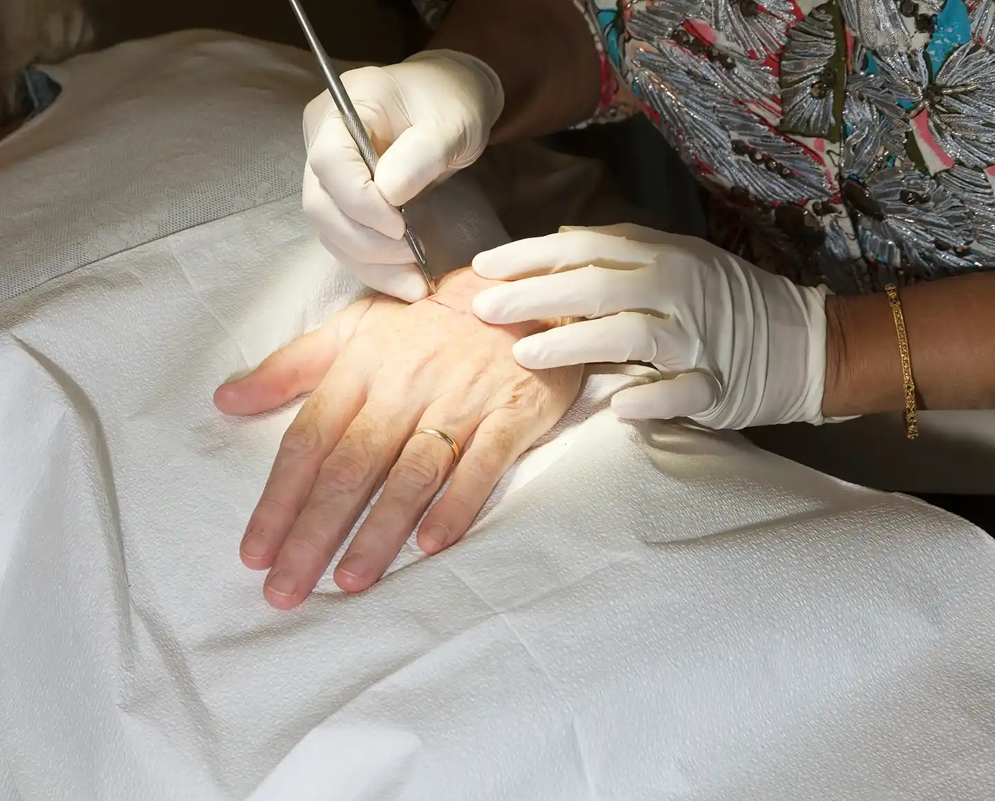 A gloved hand uses a tool to examine or treat the back of another person's hand, which rests on a white cloth.