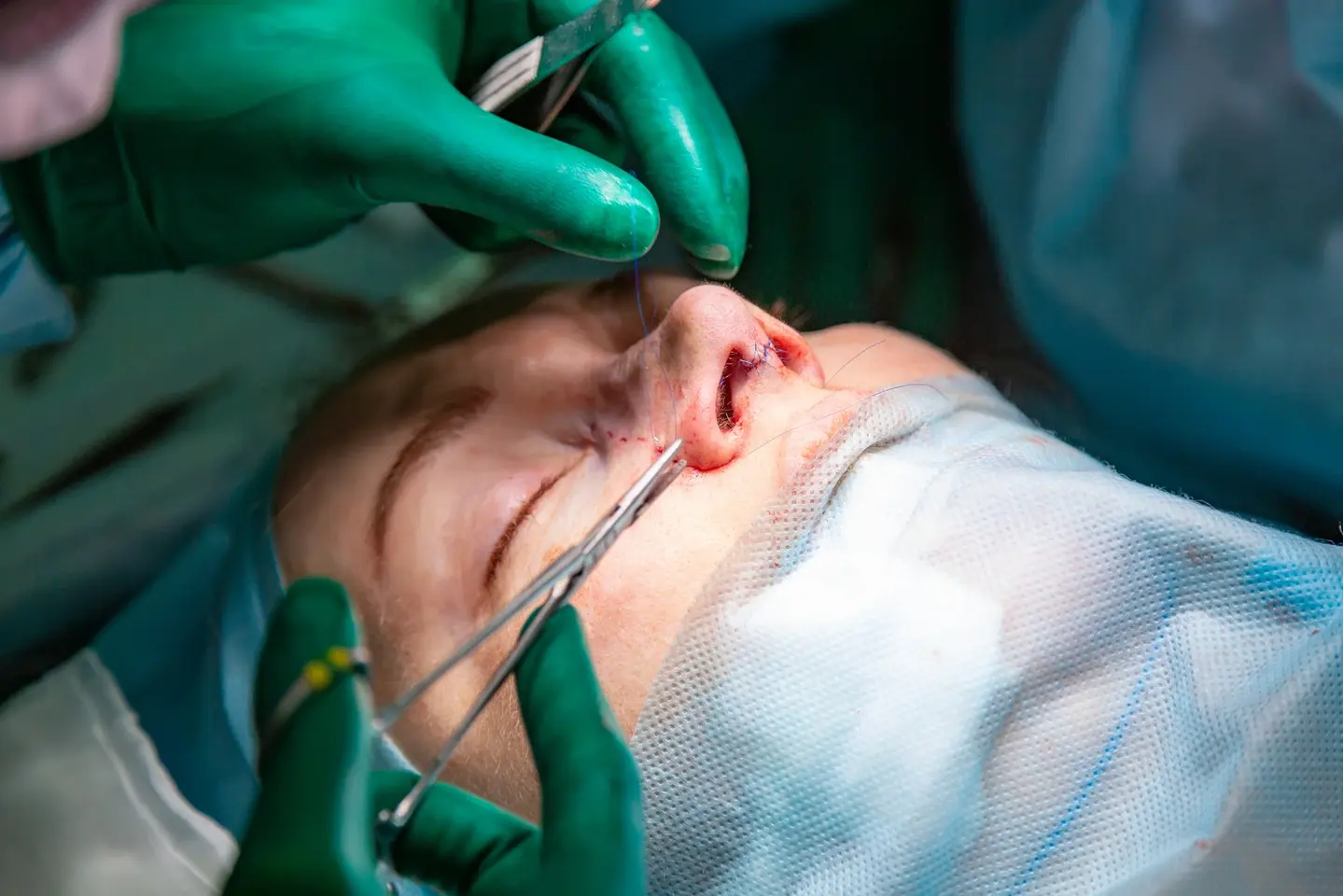 A close-up of a rhinoplasty surgery in progress, showing gloved hands stitching a patient's nose. The patient is draped in blue surgical coverings.