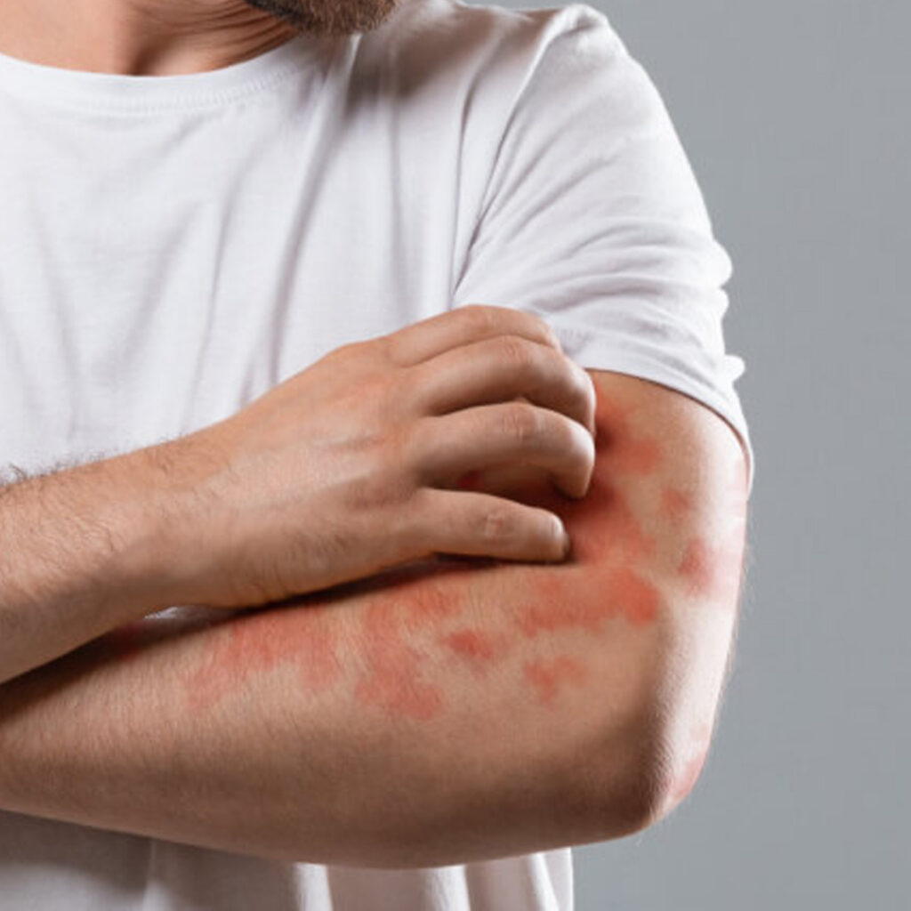 Man itching eczema on arm
